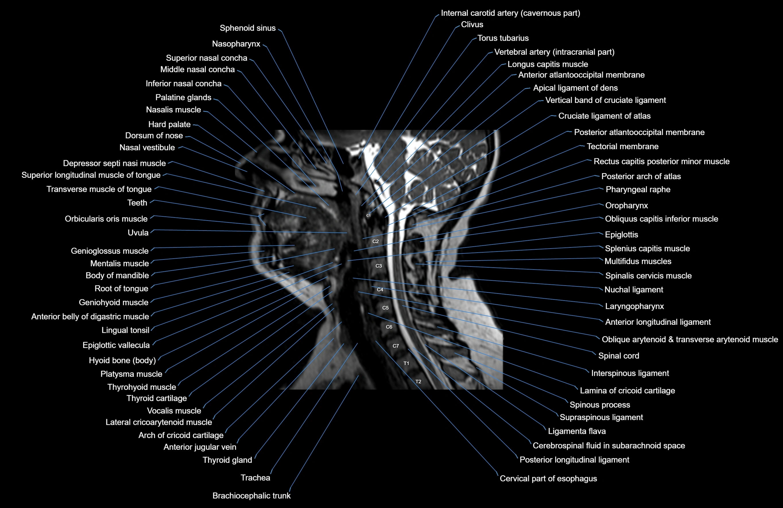 Neck MRI sagittal cross sectional anatomy 3D 1mm 3T radiology  image-img-00001-00006.webp